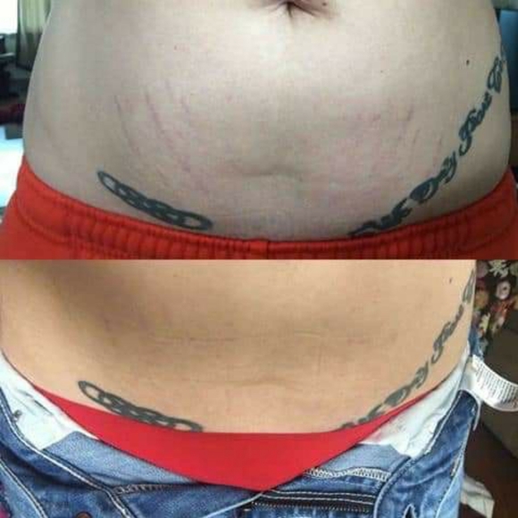 PREORDER ONLY ByeBye Stretch Marks,Mosquitos,Burns - Picture 7 of 16